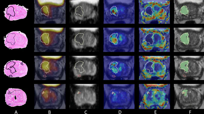 AI-Driven Radiomics for Precision Prostate Cancer Therapy